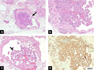 Hiperplasia papilar endotelial (tumor de Masson). A) A poco aumento podemos observar un vaso sanguíneo con una lesión intravascular de aspecto papilar (flecha) (HE,4x). B) A mayor aumento observamos que se trata de una lesión compuesta por estructuras papilares con tallos hialinos y fibrosos y anastomosis de canales vasculares (HE,10x). C) En otro vaso podemos observar de nuevo otra proliferación endotelial con las características estructuras papilares (HE,10x). D) La inmunorreacción positiva para CD34 demuestra el carácter vascular de la lesión (CD34,10x).