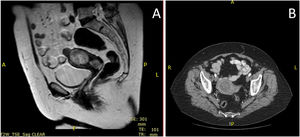 Estudio de extensión. A) Resonancia magnética nuclear: describe lesión en cuerpo uterino de 4×4,3cm de diámetro con una intensidad intermedia, que restringe en la secuencia de difusión y en el estudio dinámica se observa un leve realce heterogéneo; esta lesión es sugestiva de mioma sin poder descartar áreas de degeneración sarcomatosa. A nivel cervical se observa otra lesión de características similares que mide 2,3×2cm de diámetro, que también restringe en la secuencia de difusión y que puede corresponder con la lesión polipoidea descrita en la información clínica. No existe afectación de los parametrios, vagina ni sobrepasa serosa. No presenta adenopatías retroperitoneales. B) TAC toracoabdominopélvica: describe hallazgos similares a la RM; el resto del estudio toracoabdominopélvico, sin alteraciones destacables.