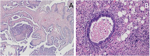 Estudio anatomopatológico de la pieza quirúrgica. Fotografía de tinción hematoxilina-eosina. A) Estudio de trompa de Falopio, carcinoma seroso×4. B) Estudio de histerectomía, carcinosarcoma ×10.