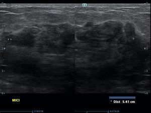 Mamografía en proyección cráneo-caudal (A) y oblicua mediolateral (B). No se visualiza claramente la masa por mamas densas.