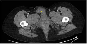 Angio-TAC. Corte transversal. Se objetiva zona de hematoma marcada con punto amarillo. El color de la figura solo puede apreciarse en la versión electrónica.