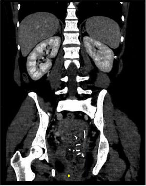 Angio-TAC. Corte coronal. Se objetiva zona de hematoma marcada con punto amarillo. El color de la figura solo puede apreciarse en la versión electrónica.