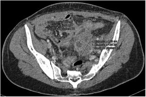 Absceso pélvico paraovárico izquierdo que presenta áreas quísticas de paredes engrosadas, compatible con una infección por gérmenes anaerobios. En el cultivo microbiológico se aisló Actinomyces turicensis.