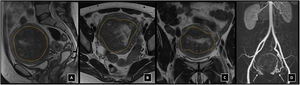 Adenomiosis. RM de pelvis en secuencia potenciada en T2, cortes sagital (A), axial (B) y coronal (C), donde se observa útero aumentado de tamaño, con un aumento difuso del grosor de la zona de unión (líneas discontinuas) subendometrial, que se encuentra mal delimitada y muestra baja intensidad en T2, compatible con adenomiosis. D) angio-RM donde se aprecia hipertrofia de arterias uterinas de forma bilateral (flechas).