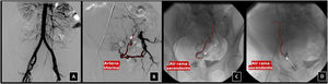 Procedimiento EAU bilateral en paciente con leiomiomas uterinos sintomáticos. A) Aortografía inicial a través acceso arterial femoral derecho para planificación vascular. B) Arteriografía selectiva desde la division anterior de la arteria ilíaca interna izquierda, donde se identifica AU hipertrófica (línea discontínua roja). C) Arteriografía superselectiva con microcatéter (flecha señalando la punta del microcatéter), donde se observa la rama ascendente de AU (línea discontínua roja), desde donde se llevó a cabo la embolización con partículas. D) Arteriografía superselectiva (flecha señalando la punta del microcatéter) desde rama ascendente de AU derecha desde donde se completó la embolización.