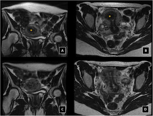 Leiomioma subseroso. A-B) RM de pelvis previa a la embolización. Secuencias potenciadas en T2, cortes coronal (A) y axial (B) donde se observa lesión nodular hipointensa en fundus uterino (asteriscos), en relación con leiomioma subseroso. Mismas secuencias y cortes coronal (C) y axial (D) RM de pelvis control 12 meses después de EAU bilateral con partículas, donde se observa resolución del leiomioma subseroso descrito en RM previa al procedimiento.