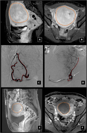 Leiomioma. A-B) RM de pelvis previa a la embolización. Secuencias T1 con saturación grasa después de la administración de contraste, cortes sagital (A) y axial (B) donde se observa voluminosa (> 10 cm) lesión nodular hipercaptante en fundus uterino (línea discontinua), en relación con leiomioma mural. C) Arteriografía selectiva de la AU derecha (flecha discontinua roja). D) Arteriografía superselectiva con microcatéter (flecha señalando punta del microcatéter) de la AU izquierda (línea discontinua roja) por abordaje femoral derecho. E-F) RM de pelvis control 12 meses después de EAU bilateral con partículas. Mismas secuencias (T1 saturación grasa tras contraste) cortes sagital (E) y axial (F), donde se observa disminución del tamaño e hipocaptación por necrosis del leiomioma mural (línea discontínua).