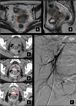 Carcinoma cérvix estadio IV. A-B) RM de pelvis en paciente con carcinoma de cérvix estadío IV. Secuencias potenciadas en T2 axial (A) y sagital (B), donde se observa masa cervical (cuadrado). La paciente acude a urgencias por metrorragia y anemización. C-D-E) Se realiza angio-TC urgente donde se observa masa necrótica con foco de extravasación de contraste en las sucesivas fases del angio-TC (círculos) fases: C) sin contraste, D) arterial y E) portal, compatible con sangrado activo en lecho tumoral (círculo). F) Arteriografía de arteria iliaca interna derecha por abordaje femoral derecho, donde se confirma foco de sangrado activo (flecha).