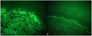 (A) Linear IgG deposits at the dermoepidermal junction. (B) Linear C3 deposits at the dermoepidermal junction.