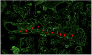 Focal, segmental and linear IgG deposits in villous basement membrane, predominantly in medium and large villi. C3 presented a similar pattern.