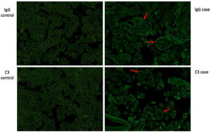 Comparison of the immunofluorescence image of the placenta of our case patient versus a healthy control case (similar gestational age and placental weight).