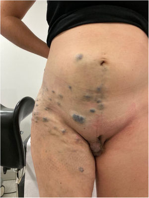 Lesiones vasculares en hemicuerpo inferior derecho.