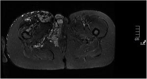 Estructuras vasculares dilatadas en pelvis y periné, sobre todo afectando a la vulva.