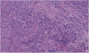 Imagen histológica. Tejido muscular liso infiltrado por grandes nidos y sábanas de células de poco citoplasma con diferenciación glandular (HE 20X). HE: hematoxilina y eosina.