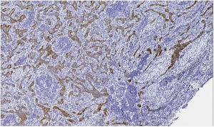 Estudio inmunohistoquímico. Calretinina positiva (10X).