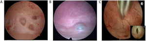 Hallazgos histeroscópicos característicos de Adenomiosis. A) Presencia de endometrio irregular con pequeños orificios (criptas). B) Patrón de hipervascularización. C) Lesiones quísticas hemorrágicas subendometriales (de contenido achocolatado).