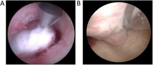 En la imagen se muestra morcelación histeroscópica de mioma submucoso tipo 0 (A) y morcelación histeroscópica de pólipo endometrial de> 2cm (B).