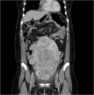 Radiological findings of the case by abdominal–pelvic CT (sagittal section).