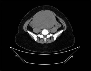 Radiological findings of the case by abdominal–pelvic CT (axial section).