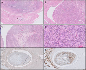 Pathological study of the surgical specimen. Hematoxylin–eosin staining. The arrow indicates the focal intravascular invasion of uterine leiomyomatosis. A: Hematoxylin–eosin staining (HE) (10×). Uterine leiomyomatosis showing focal vascular invasion (arrow). B: HE (20×). Venous wall with non atypical spindle cell growth in the lumen, resembling an ordinary leiomyoma. C: HE (50×). Intravascular smooth muscle with numerous thick-walled vessels, fibrosis and hialinization. D: HE (200×) Elongated spindle cells without atypia or necrosis and scarce mitotic activity. E, F: Positive immunostain for smooth muscle cells. E, actina (100×). F, desmina (100×).