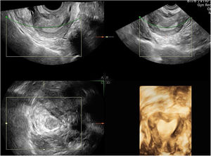 Transvaginal ultrasound image showing a septum uterus. Absence of ovaries during examination.