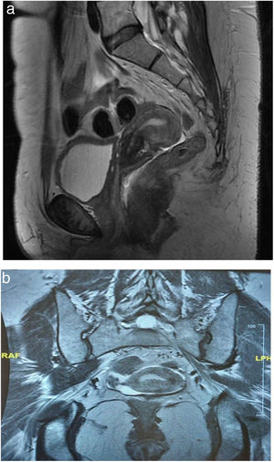 (a) Magnetic resonance sagittal section showing a well-shaped retroverted uterus. Absence of ovaries. (b) Magnetic resonance coronal section showing uterus and one of the gonadal bands.