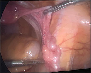 Laparoscopic image of an underdeveloped gonad during surgery (double gonadectomy).
