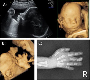A) Ecografía 2D y reconstrucción tridimensional en modo superficie donde se aprecia facies pequeña con prominencia frontal. B) Reconstrucción tridimensional en modo superficie de la mano derecha donde se objetiva desviación radial del quinto dedo compatible con clinodactilia y posible sindactilia a nivel de la primera falange entre el cuarto y quinto dedo. C) Radiografía de la mano derecha del neonato en la que se evidencia ausencia de falange distal del quinto dedo con clinodactilia.