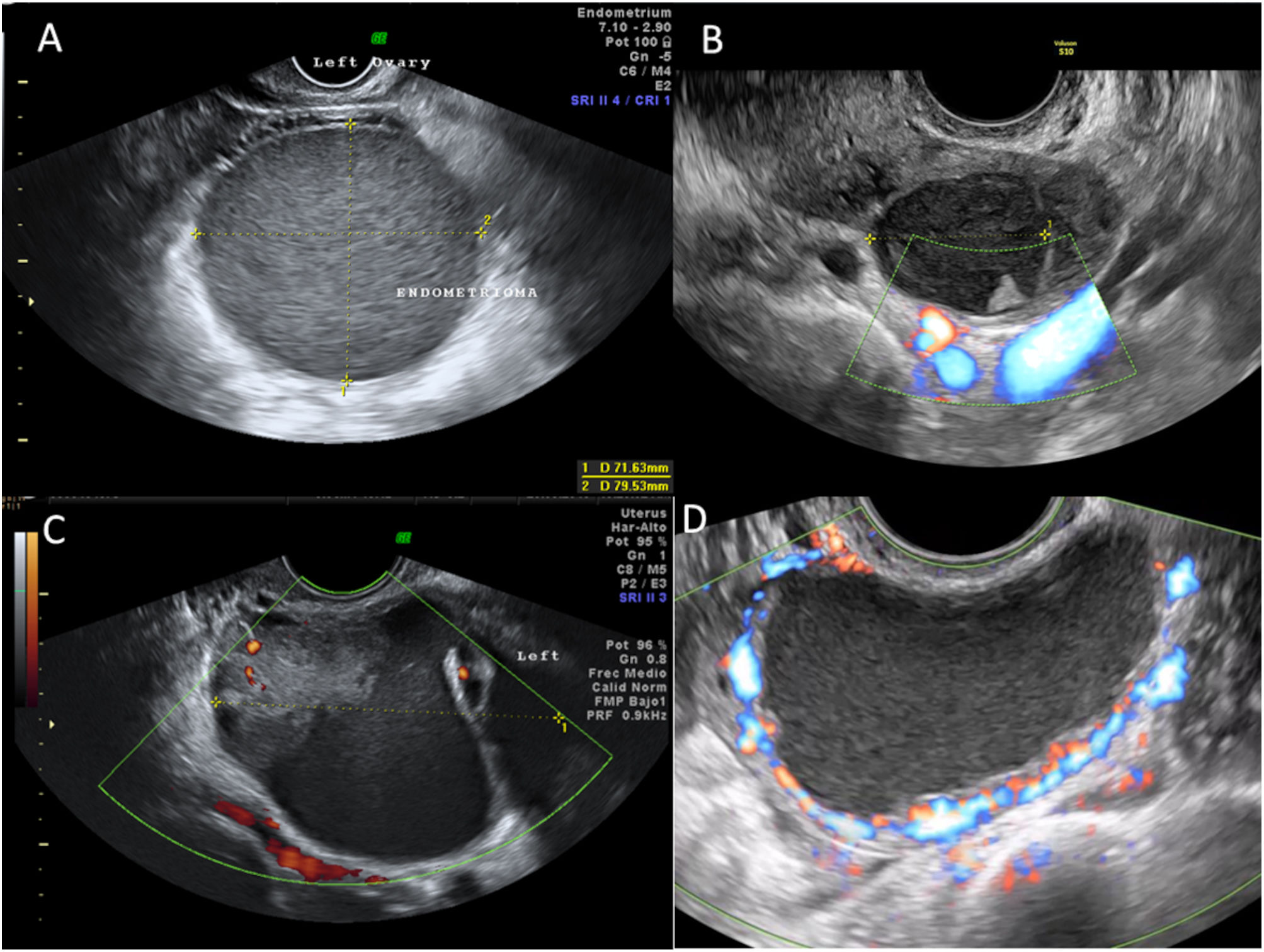 Diagn stico Ecogr fico De La Endometriosis Y Los Miomas Cl nica E diagn-stico-ecogr-fico-de-la-endometriosis-y-los-miomas-cl-nica-e