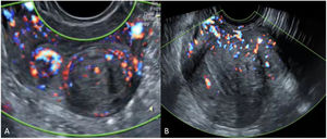 A: Mioma. Vascularización circunferencial de predominio periférico debido a la riqueza en vasos de la pseudocápsula del mioma; B: Vascularización translesional de adenomioma de pared posterior, en un útero en retroversión.