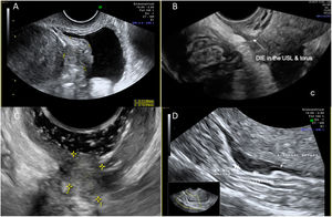 Nódulos de endometriosis profunda. A: nódulo en cúpula vesical; B: nódulo en ligamento uterosacro; C: nódulo en fórnix vaginal posterior con gel en vagina; D: nódulo en pared anterior de recto.