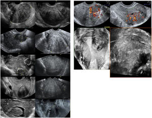 Imágenes ecográficas de las características típicas de la adenomiosis frente a las de los miomas uterinos. A)Útero con contorno lobulado (mioma) vs B)útero de morfología globulosa (adenomiosis). C)Masa bien definida (mioma) vs D)masa mal definida (adenomiosis). E)Borde hiperecogéncio (mioma) vs F)ausencia de borde (adenomiosis). G)Sombras acústicas en el borde (mioma) vs H)sombras en forma de abanico (adenomiosis). I)Ecogenicidad homogénea (mioma) vs J)ecogenicidad mixta (adenomiosis). K)Patrón de vascularización circunferencial (mioma) vs L)patrón de vascularización translesional (adenomiosis). M)Zona de transición bien definida (interrumpida si mioma submucoso) vs N)zona de transición mal definida o irregular (adenomiosis).