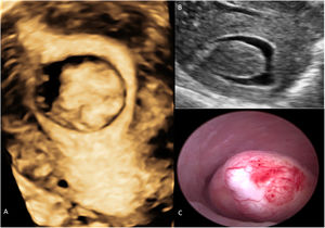 A)Reconstrucción tridimensional del plano coronal en el que se observa un mioma submucoso. B)Mismo mioma objetivado mediante imagen bidimensional (plano sagital medio) tras inyección endocavitaria de solución salina (sonohisterografía). C)Imagen del mismo mioma obtenida por histeroscopia.