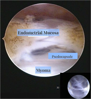 Seudocápsula de mioma vista por histeroscopia (Dr. Haimovich).