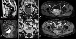RMN de pelvis: antes de la inmunoquimioterapia, útero lateralizado hacia la derecha, de contornos lobulados, con múltiples miomas subserosos, intramurales y submucosos. Lesión ovalada de bordes definidos de 58×23mm localizada en el borde izquierdo de la unión vagina-cérvix, con adecuada interfase con la vejiga y el recto, de señal intermedia en T1 (A) y baja en T2 (B), capta el contraste periféricamente (C). Sin adenopatías en la cadenas ilíacas. Tras la inmunoquimioterapia, útero de aspecto hipotrófico con presencia de hasta 8 lesiones sólidas hipointensas de bordes bien delimitados con escaso realce a la administración de contraste, el mayor de ellos de 16mm en la pared anterior, compatible con miomas. El endometrio, cérvix y endocérvix muestran caracteres morfológicos y de señal conservados, tanto en T1 con contraste (D y F) como en T2 (E). Sin adenopatías en cadenas ilíacas.