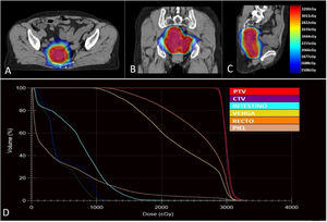 Dosimetría de irradiación externa: mediante el color wash de las dosis de radiación, se observa que la dosis del 99% cubre la totalidad del PTV (rojo); así mismo, se aprecia el decaimiento de la dosis al 50% a partir de 2cm del PTV, lo que favore la protección de los órganos de riesgos cercanos, como vejiga, recto e intestinos (A, B y C). En el histograma dosis-volumen, se aprecia la buena conformidad, tanto del CTV como del PTV, encontrándose por encima del 95% de conformidad; así mismo, la dosis media en recto, vejiga e intestino es de 25,6Gy; 22,5Gy y 7,4Gy, respectivamente (D).