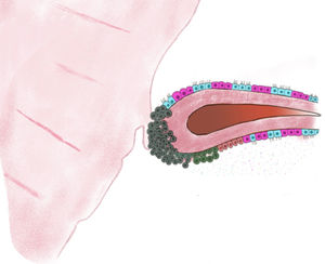 Diagram of a fimbrial plica showing the attachment of an ovarian fimbria (right) to the ovary (left). The fallopian tube epithelium (FTE) is composed of a single layer of secretory and ciliated cells; “genetic hits” allow cells to acquire a proliferative capacity, leading to clonal expansion of normal-appearing FTE cells with a secretory phenotype, giving rise to serous tubal intraepithelial carcinoma (STIC). As STIC progresses to invasive serous carcinoma, malignant cells exfoliate from the fimbria and rapidly spread to the surface of the peritoneum and/or ovary. Exfoliation may occur prior to fimbrial invasion. Note the continuity of the epithelium of the fimbria and the ovarian surface epithelium; these structures become separated in the course of embryonic development, except for a remnant of this connection that persists in the adult, the ovarian fimbriae, which form a narrow isthmus extending from the oviduct onto the ovary.