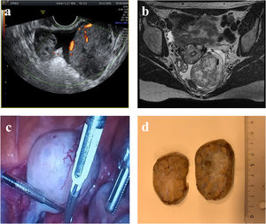 (a) Transvaginal ultrasound revealed a solid hypoechoic tumor with cystic areas and regular borders with multiple vessels in the periphery and central part. The right ovary was normal. A small amount of free fluid was present. (b) MRI revealed an ovoid solid tumor with regular contours. (c) On laparoscopy a solid lobulated mass with a high vascularized capsule depending of the left ovary was found. (d) Macroscopic examination revealed a capsulated tumor with firm consistency and yellowish nodular peripheral components and an oedematous central part.