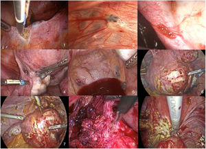 Imagen laparoscópica de los diferentes tipos de endometriosis. 1.Endometriosis peritoneal sobre uréter derecho. 2.Endometriosis típica subperitoneal (lesión negra). 3.Endometriosis peritoneal activa (lesión roja). 4.Implante peritoneal sobre ovario izquierdo. 5.Implantes peritoneales antiguos y defectos peritoneales en Douglas. 6.Adenomiosis uterina anterior. 7.Útero adenomiótico tras disección peritoneal anterior. 8.Implante endometriósico profundo en cara anterior de recto. 9.Implante endometriósico profundo en torus uterino.