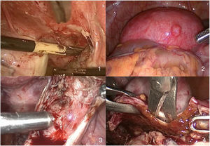 Imagen laparoscópica de visión y manejo de endometrioma ovárico. 1.Endometrioma ovárico bilateral con adherencias fibrosas a hoja posterior de ligamento ancho. 2.Endometriomas ováricos subperitoneales con endometriosis profunda asociada y Douglas obliterado. 3.Ablación de cápsula del endometrioma con tecnología Plasmajet®. 4.Plano de clivaje del endometrioma en quistectomía laparoscópica.