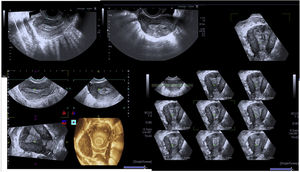Ecografía transrectal en 3D del caso 3.