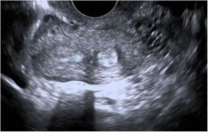 Ecografía transvaginal del caso 4.