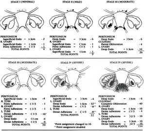 Staging classification from the American Society of Reproductive Medicine.