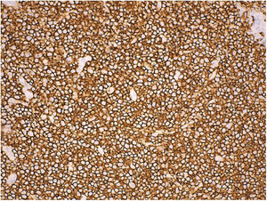 Inmunohistoquímica con positividad muy marcada para CD20.