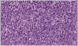 Imagen histológica. Células fusiformes dispuestas en fascículos entrecruzados y figura de mitosis. (Hematoxilina y eosina ×20).