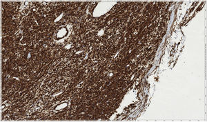 Estudio inmunohistoquímico. Actina 1A4 positiva (×20). HE: hematoxilina y eosina.