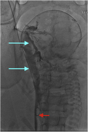 Iliocavografía realizada mediante acceso percutáneo a través de vena femoral común derecha. Nótese el colapso de la vena cava inferior (flecha inferior) secundario al útero grávido con la congruente ectasia del eje venoso ilíaco derecho y discreta colateralidad pélvica (flechas superiores).
