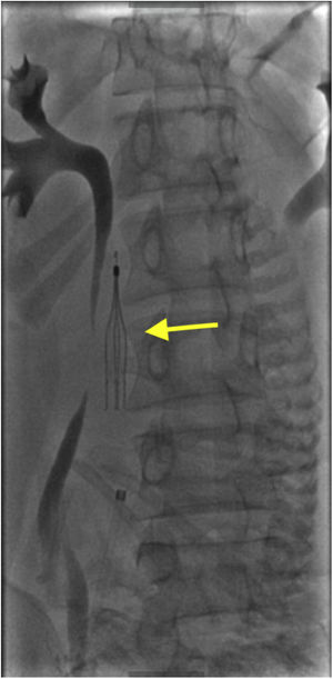 Filtro en vena cava inferior infrarrenal (flecha). Se puede apreciar una expansión incompleta del dispositivo por el colapso de la vena cava, aunque adecuadamente acoplado al calibre vascular y funcional. Una vez cursado el parto, el dispositivo se acoplará al nuevo calibre venoso.