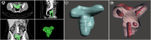 (A) CT scan of the pelvis, selection of the structures. (B) 3D virtual reconstruction of the selected structures (double uterus and vaginas). (C) Middle section of the uterus showing double uterus, and one opened vagina and the obliterated vagina. (D) Resection of the longitudinal vaginal septum by vaginoscopic.