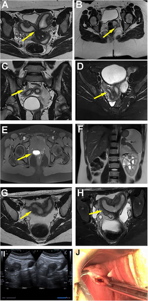 (A) Pelvic MR, sequential axial cuts T2: it is identified a uterus didelphys with a longitudinal vaginal septum (arrow). (B) Presence of two hemivaginas. Enlarged left hemivagina and with hyperintense content as regards hematocolpos (arrow). (C) Uterus didelphys (arrow). (D) Arrow shows hyperintense content in the left hemivagina (hematocolpos). (E) Cystic image of the postero-lateral left wall of the bladder regarding the ureterocele (arrow). (F) Left renal agenesis. (G and H) pelvic MR, sequences T2 axial and coronal; uterus didelphys (arrow). (I) Abdominal ultrasound showing the double uterus. (J) Resection of the longitudinal vaginal septum by vaginoscopic.